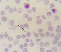 Thalassemia major case with Howell-jolly bodies and increased NRBC 1