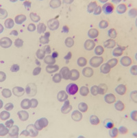 Thalassemia major case with Howell-jolly bodies and increased NRBC 2