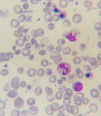 Thalassemia major case with Howell-jolly bodies and increased NRBC 4