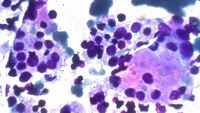 Neuroblastoma mimicking Acute Lymphoblastic Leukemia 2