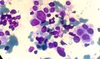 Neuroblastoma mimicking Acute Lymphoblastic Leukemia 4