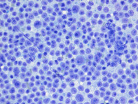 Mantle cell lymphoma expressing P53
