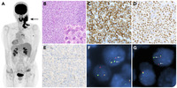 “Double-hit” of DUSP22 and TP63 rearrangements in anaplastic large cell lymphoma, ALK-negative