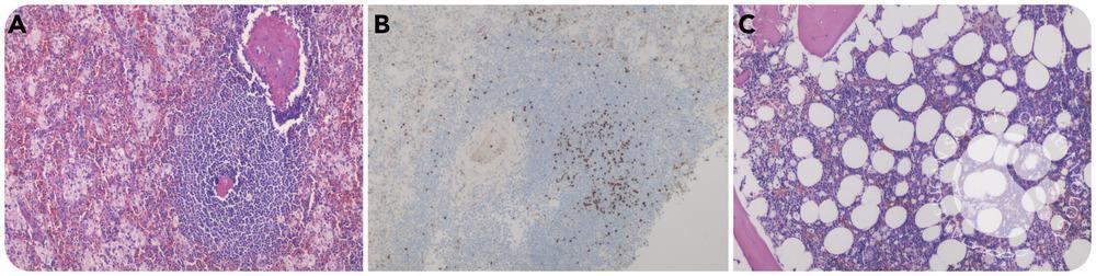 Niemann-Pick disease with isolated leukemic nonnodal mantle cell lymphoma of the spleen