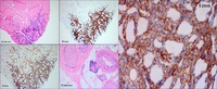 Diffuse Large B-cell Lymphoma Involving Muscle and Nerve