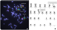 MYC and KMT2A multiple extra copies in acute myeloid leukemia