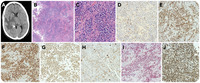 Extracavitary primary effusion lymphoma presenting as a thalamic mass in a patient with multicentric Castleman disease