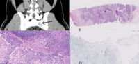 Secondary myelofibrosis as paraneoplastic phenomenon in patient with signet ring adenocarcinoma