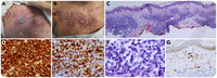 The fertile field of “isomopic” immune dysregulation as a nidus for lymphoproliferative disorders