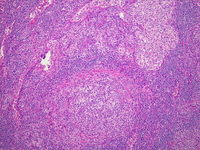 Mast cell infiltrate and sinus histiocytosis; H&E; 100X objective.