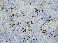 IgG4 immunostain; 200X objective.