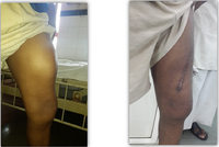 pseudotumour of thigh pre and post surgery