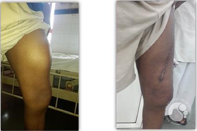 pseudotumour of thigh pre and post surgery