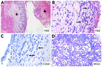 Placental myeloid sarcoma