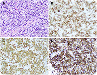 An IgA plasmacytoma: a rare and distinct form of plasmacytoma