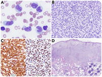 Acute leukemic variant of blastic plasmacytoid dendritic cell neoplasm at initial presentation