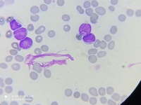 Myeloblast with cup-like nuclear invagination 1