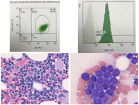 B-lymphoblastic leukemia, BCR-ABL1-like