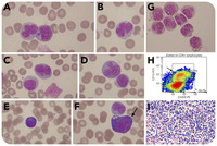 Circulating angioimmunoblastic T-cell lymphoma cells