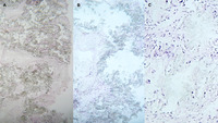 Bone marrow oxalosis