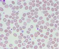 Incidental finding of Southeast Asian Ovalocytosis