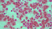 Refractory anemia with ring sideroblasts