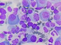 Plasma Cell in case of Plasma Cell Myeloma 1
