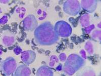 Plasma Cell in case of Plasma Cell Myeloma 3