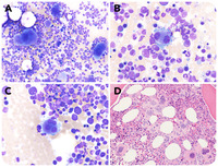 MDS/MPN-U with persistent monocytosis, del(20q), and CALR mutation, the great masquerader