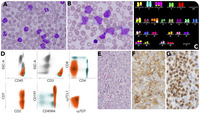 Peripheral T-cell lymphoma, NOS, with rapidly progressing leukocytosis mimicking acute lymphoblastic leukemia