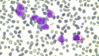 acute promyelocytic leukemia microgranular variant