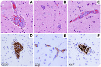 Intravascular large B-cell lymphoma presenting with acute encephalopathy