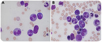 A striking case of iatrogenic granulocytic nuclear abnormality in the bone marrow