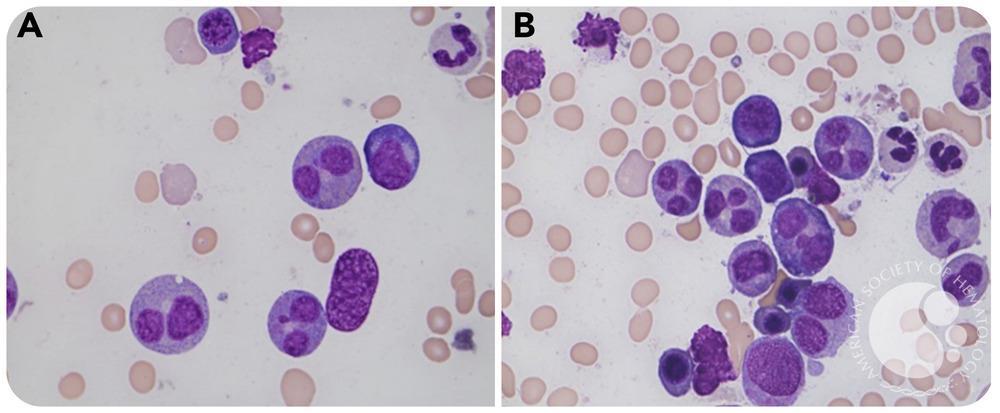 A striking case of iatrogenic granulocytic nuclear abnormality in the bone marrow
