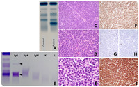 γ heavy chain disease presenting in a patient with systemic lupus erythematosus