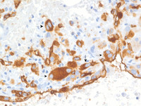 AML with inv(3)- BM biopsy- CD34