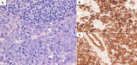 Extramedullary Myeloid Tumor- Lymph node Biopsy