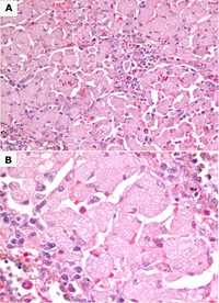 Gaucher disease