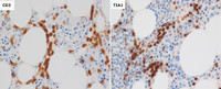 T-cell large granular lymphocytic leukemia- CD3 and TIA1