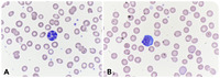 Hypersegmented granulocytes and COVID-19 infection