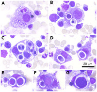hemophagocytic-lymphohistiocytosis-associated-with-polyserositis