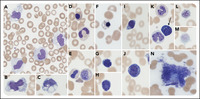 Morphological changes in a case of SARS-CoV-2 infection