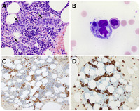 Hemophagocytic syndrome–associated intravascular large B-cell lymphoma