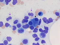 Therapy-related Myeloid Neoplasm- Bone marrow Aspirate 3