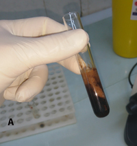 Urine findings in DIC (Scorpion sting)