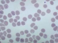 Severe Malaria Blood Smear