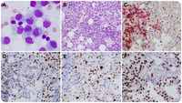 Simultaneous bone marrow involvement by CLL/SLL and LEF1/cyclin D1-positive metastatic melanoma