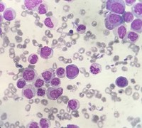 Morphological curiosity in MDS/MPN: Syndrome of Abnormal Chromatin Clumping 1