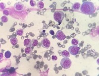 Morphological curiosity in MDS/MPN: Syndrome of Abnormal Chromatin Clumping 2