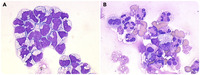 Drug-induced aseptic meningitis in a Ph ALL patient with meningeal involvement